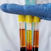 A medical professional in blue gloves holds three test tubes of separated blood components, representing Platelet-Rich Plasma orthobiologic therapy.