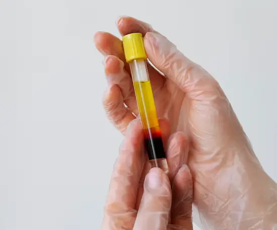 Illustration of plasma protein concentration process in PRP highlighting separation from platelet poor plasma
